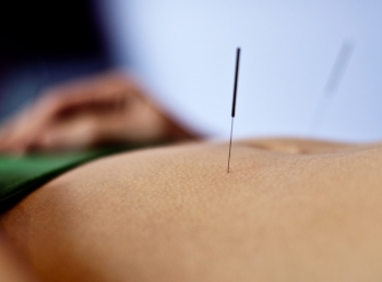 Acupuncture